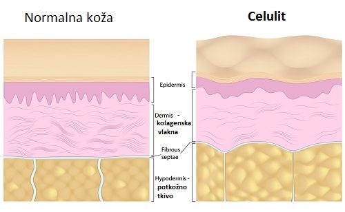 normalna koža vs celulit