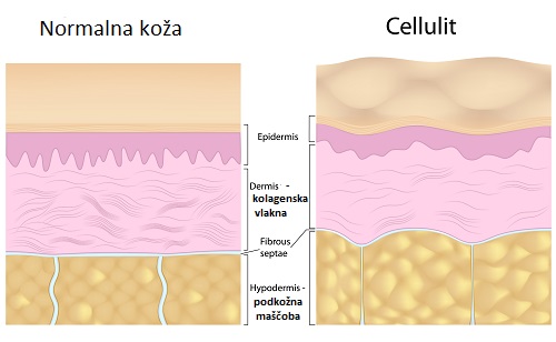 Normalna koža vs Cellulit normalna koža vs celulit